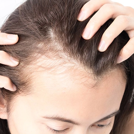 Best Hair Loss/Fall Treatment at Best Price in Chennai Affordable hair loss treatment in Chennai to reduce hair fall and stimulate new hair growth