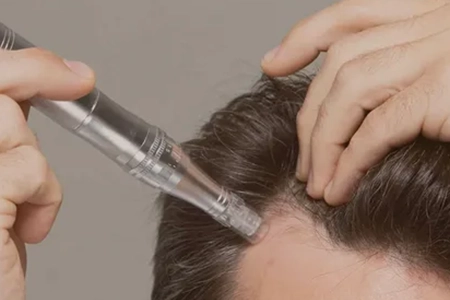 Microneedling Hair Growth Boosting Treatment Hub, Chennai Close-up of microneedling on scalp with serums to boost hair growth and renew follicles effectively